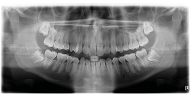 小児パノラマ 小児パノラマ