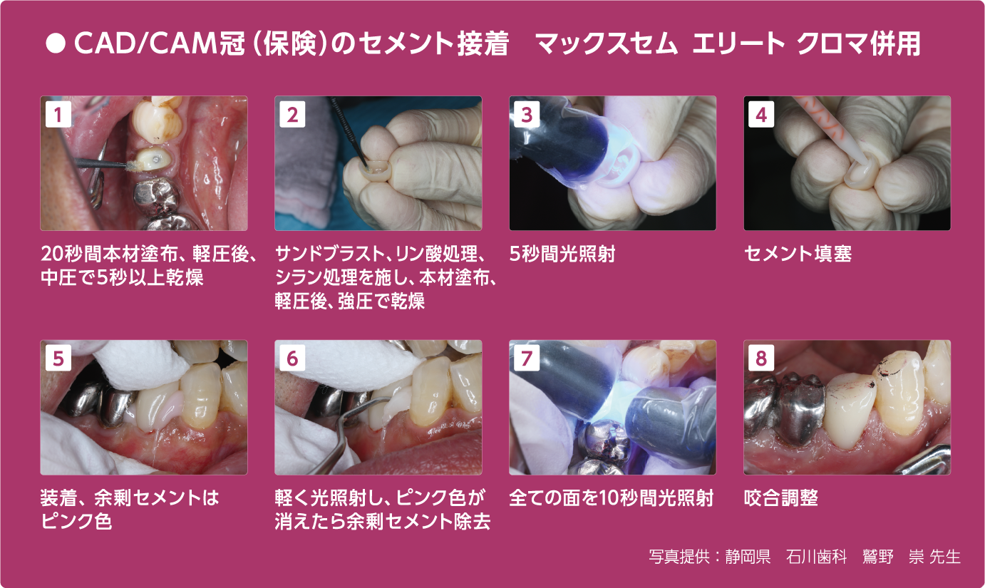 セルフアドヒーシブ型レジンセメント セルフアドヒーシブ型レジンセメント