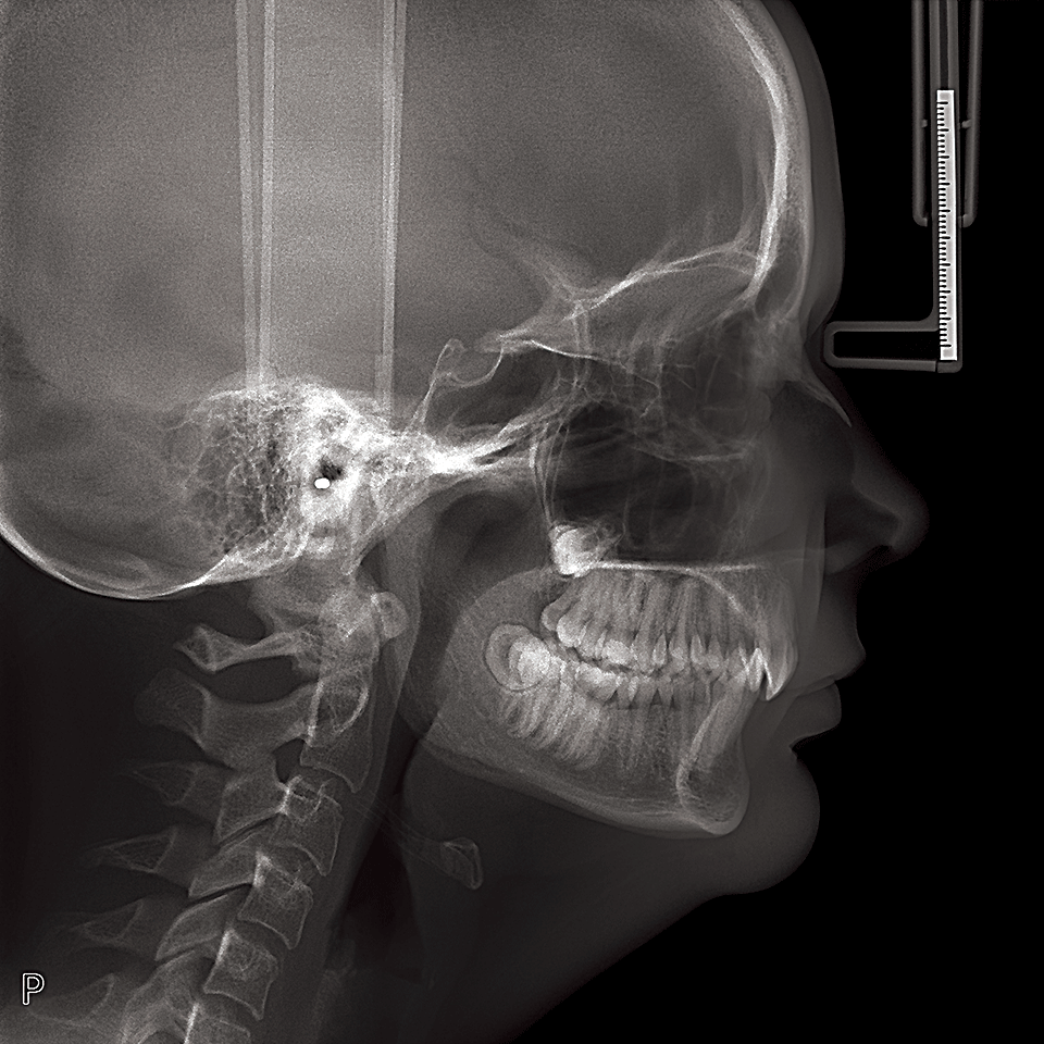OP 3D 側方セファロ画像 OP 3D 側方セファロ画像