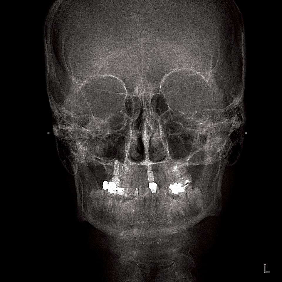 OP 3D 正面セファロ画像 OP 3D 正面セファロ画像