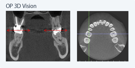 エックス線の水平入射 エックス線の水平入射