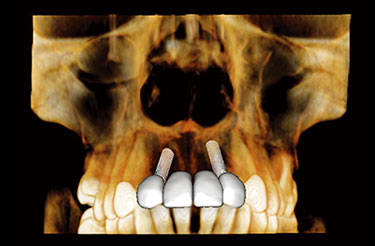 FOV Φ9 × H6cm FOV Φ9 × H6cm