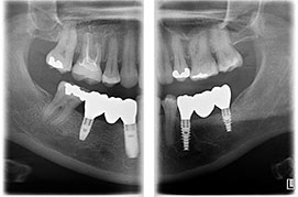 ORTHOselectTM - 部分パノラマ撮影 ORTHOselectTM - 部分パノラマ撮影